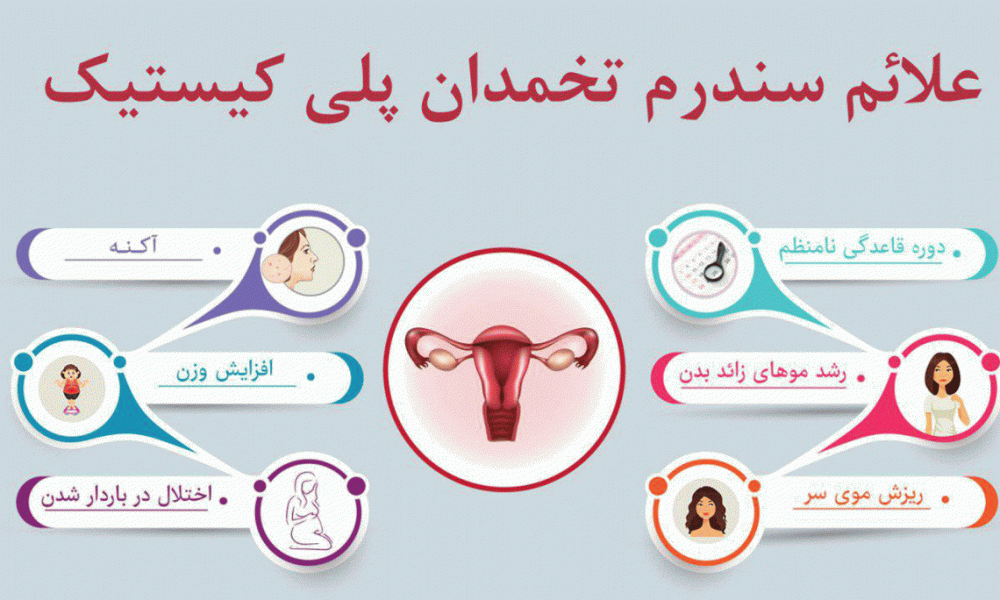 تخمدان-پلی-کیستیک-1170×684 تخمدان-پلی-کیستیک-1170x684